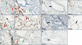 new research for dementia