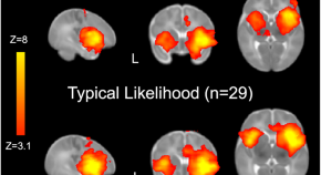 latest research on what causes autism