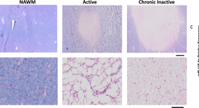 how does research help multiple sclerosis