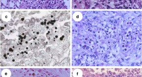 case study 57 prostate cancer