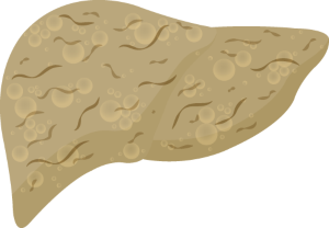 semaglutide nash results Semaglutide is safe and efficacious for NASH resolution