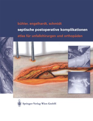 Septische postoperative Komplikationen | SpringerLink