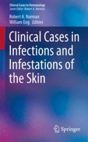 Clinical Cases In Infections And Infestations Of The Skin Springerlink