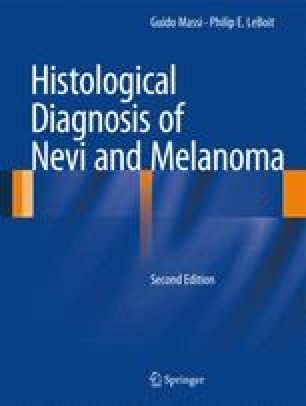 spindle cell melanoma spindle cell melanoma