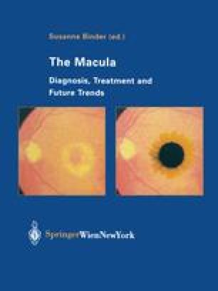 Photodynamic Therapy Pdt In Eyes With Pathologic Myopia - 