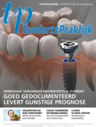 De Levensduur Van Grote Amalgaamrestauraties En Kronen Vergeleken Springerlink