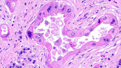 Pancreatobiliary Neoplasms image