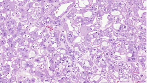 Gaucher disease involving bone (lysosomal storage disorder