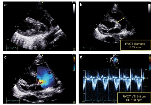Neonatologist Performed Echocardiography (NPE)