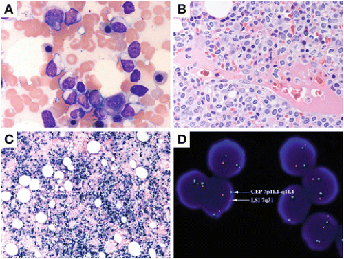 Recurrent Abnormalities in NonHodgkin’s