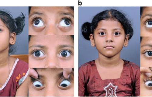 Pattern Strabismus And Torsion Needs Special Surgical Attention Eye