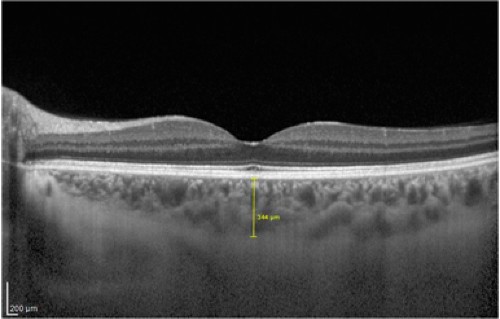 Choroidal Changes Observed With Enhanced Depth Imaging Optical Coherence Tomography In Patients With Mild Graves Orbitopathy Eye