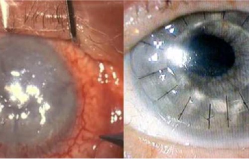 Early Deep Anterior Lamellar Keratoplasty For Fungal Keratitis Poorly Responsive To Medical Treatment Eye