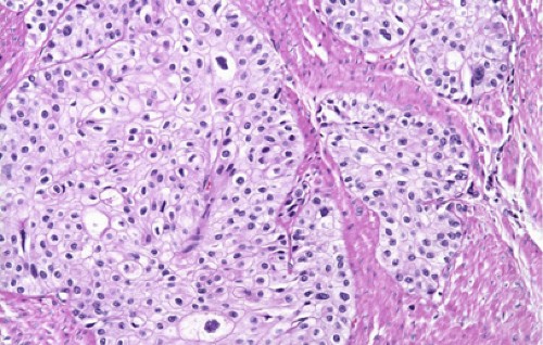 prostatic acinar adenocarcinoma pathology outlines