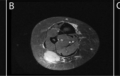 Xanthogranulomatous Epithelial Tumor Report Of 6 Cases Of A Novel Potentially Deceptive Lesion With A Predilection For Young Women Modern Pathology