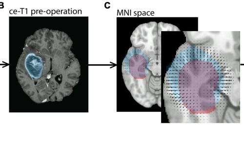 The Direction Of Tumour Growth In Glioblastoma Patients Scientific Reports