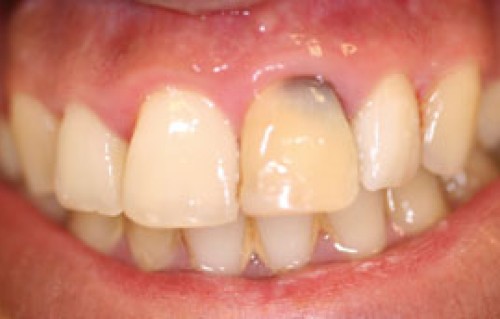Resorption Part 2 Diagnosis And Management British - 