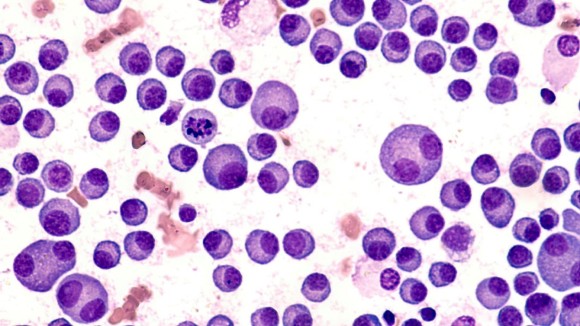 Multiple Myeloma Awareness: Bone marrow aspirate cytology of multiple myeloma, a type of bone marrow cancer of malignant plasma cells, associated with bone pain, bone fractures and anemia.