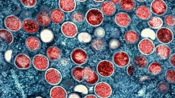 Colorized transmission electron micrograph of monkeypox particles (red) found within an infected cell (blue)