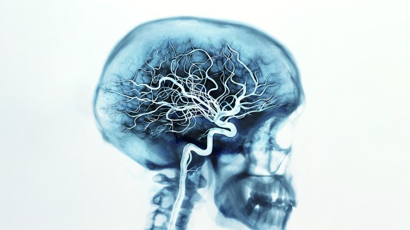 X-ray of skull showing arteries in brain (Digital Enhancement)