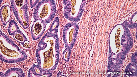Staining of a section of colorectal cancer tissue