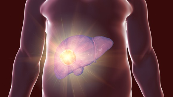 Representation of a liver cancer in human body