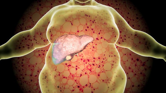 Obese person with fatty liver on background with micrograph of liver steatosis, 3D illustration