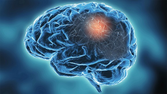 neurological disease research papers Neurodegenerative disease concept illustration with neural networks.