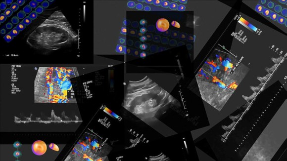 Coronary computed tomography angiography (CCTA) of the heart and coronary vessels using contrast fluid and stress and determine whether they have been narrowed. Set of results.