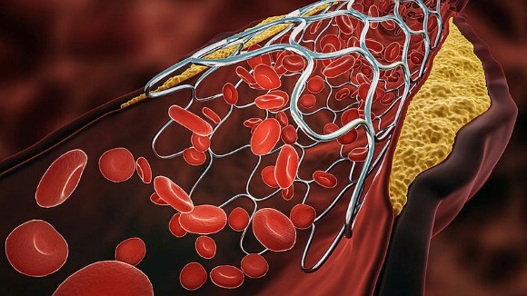 Computational Fluid Dynamics for the Study of Cardiovascular Disease