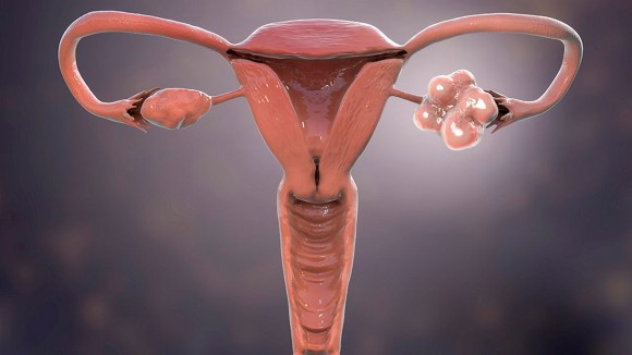 3D illustration showing healthy ovary (right) and enlarged ovary with cysts (left)