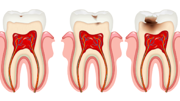 Caries progression