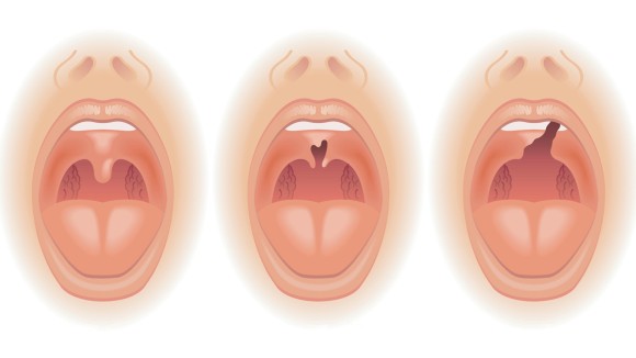 Illustration of cleft palate