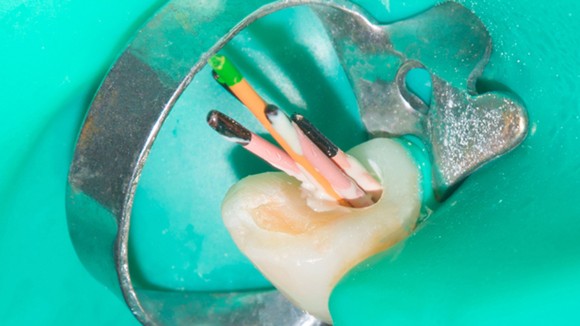 Root canal treatment equipment