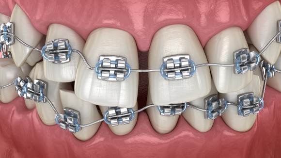 orthodontic treatment on teeth