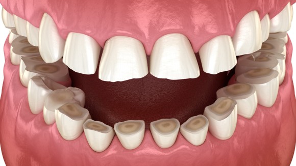 Example of tooth wear