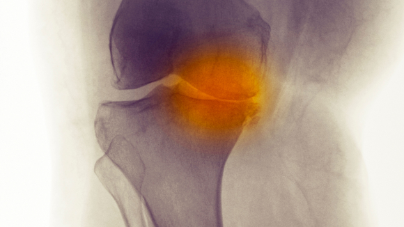 Knee x-ray of a 60 year old woman showing degenerative joint disease from osteoarthritis