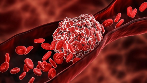 thrombosis