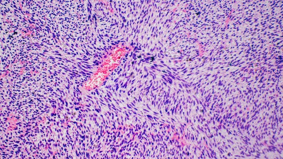 Human cancer cells fibrosarcoma, micrograph.