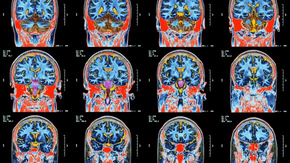 MRI scan of brain - stock illustration