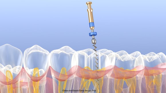 Endodontic procedure