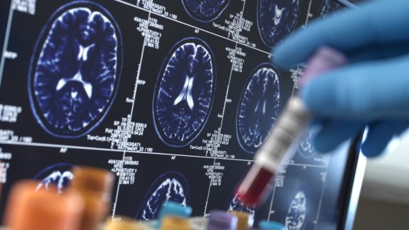 Scientist holding a blood sample during a clinical trial with a MRI on screen 