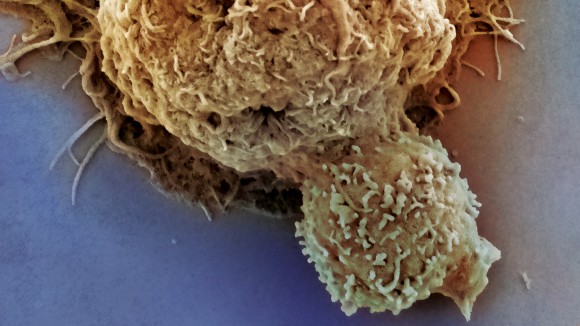 Scanning electron microscopy showing a peripheral NK cell (small cell) interacting with a HepG2 liver cancer cell (large cell)