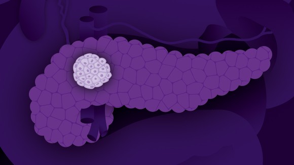 Image of pancreatic cancer in purple