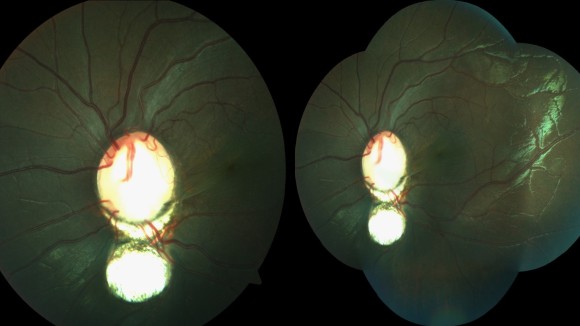 Optic disc coloboma