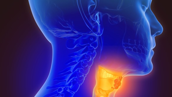 Cancer highlighted in throat