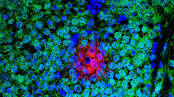 Treatment-resistant breast cancer cells. 