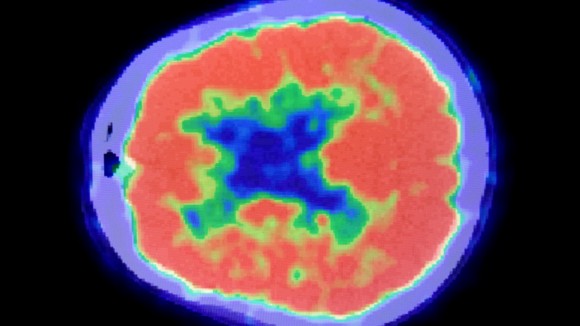 Multicoloured scan of brain.