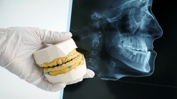 Jaw x-ray and tooth mould