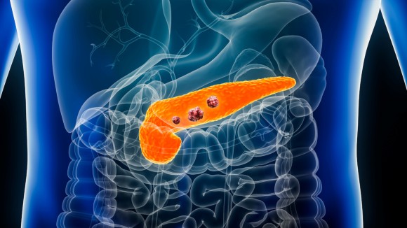 pancreatic cancer with organs